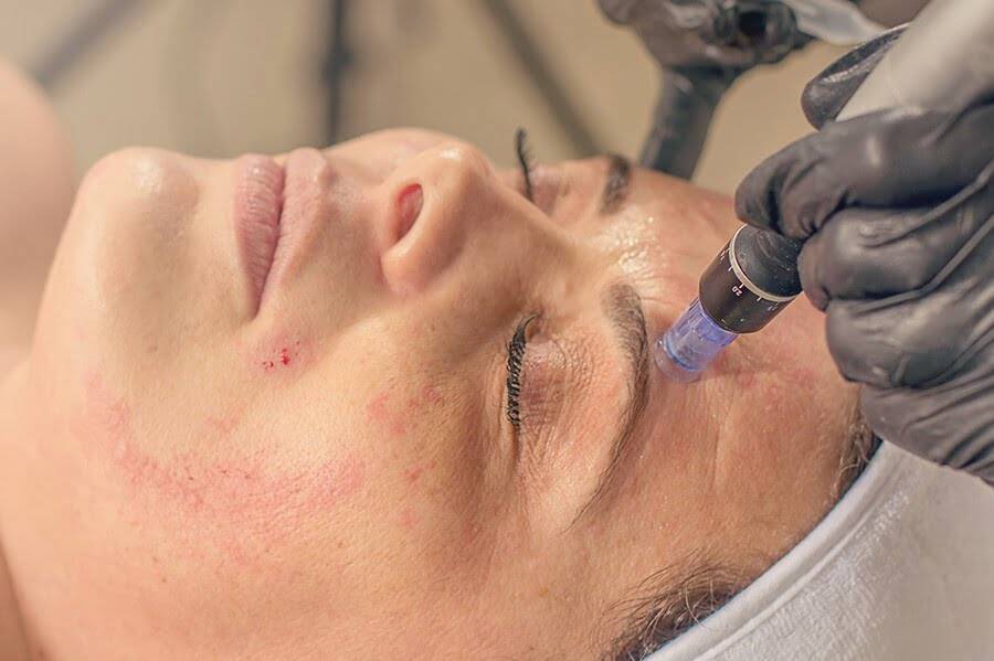 Dr. Melinda Silva MD - Microneedling Image