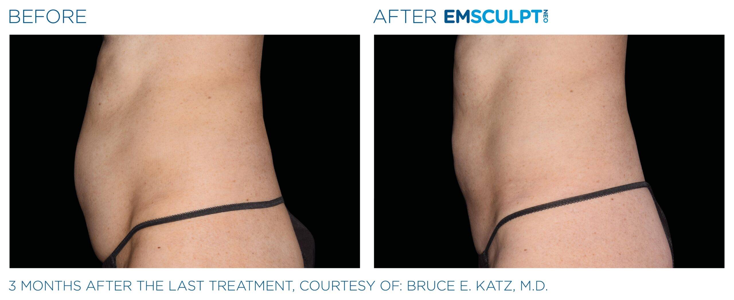 Dr. Melinda Silva MD - Result Using Emsculpt Stomach side Image