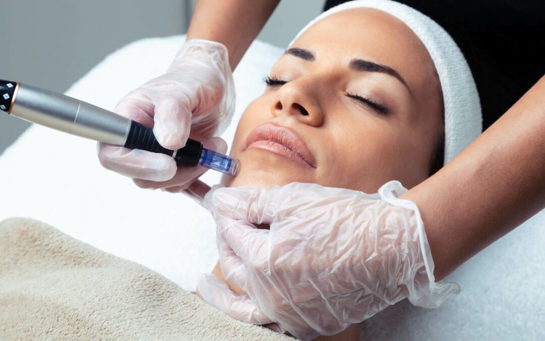 microneedling