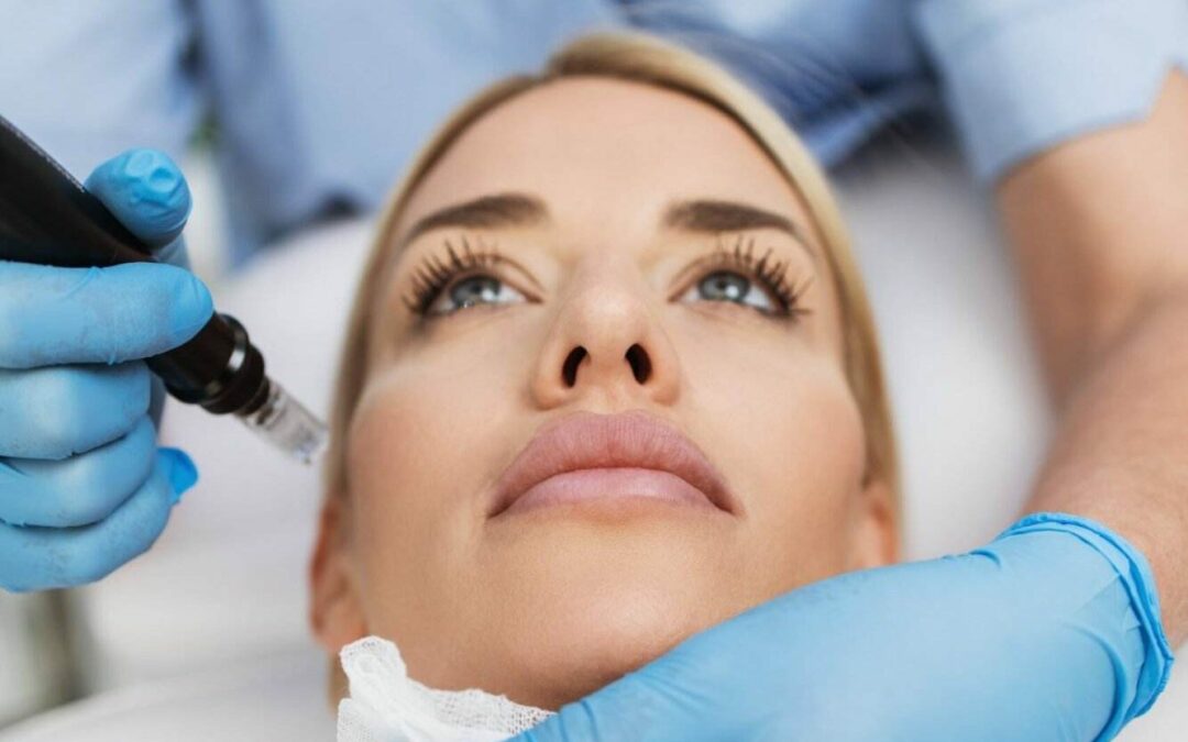 microneedling